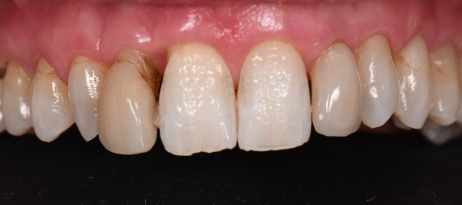 Avant – Cas clinique du Docteur Victor Hazout, après une parodontite stabilisée : espaces entre les dents et collets irréguliers, puis contour harmonisé après restauration des dents antérieures.