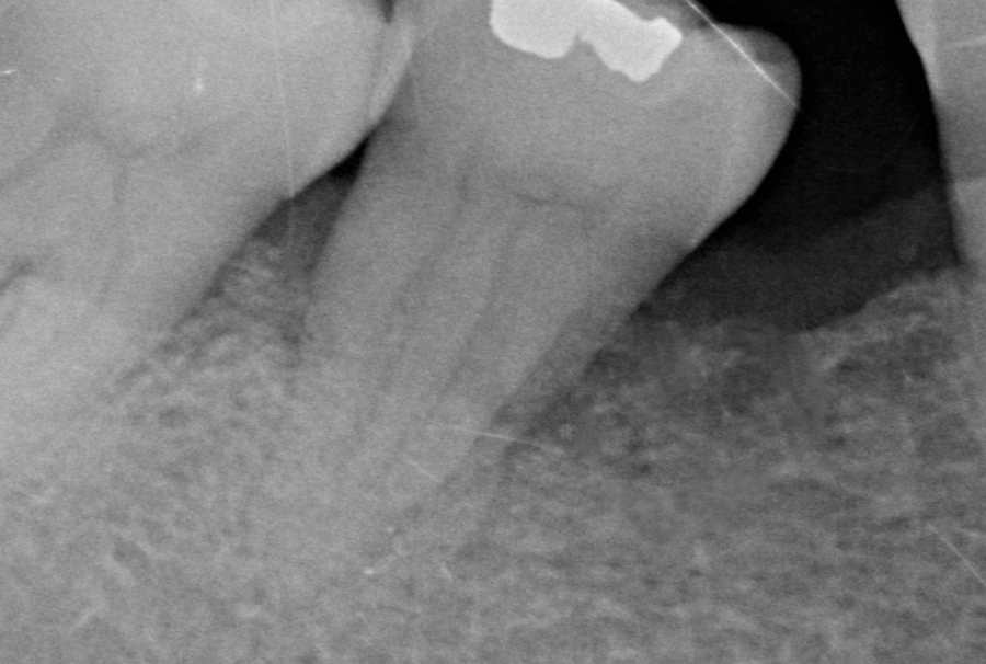 Après · 2021 – Cas clinique du Docteur Victor Hazout. Défaut osseux le long d'une molaire inférieure : radiographie avant le traitement (2014), puis sept ans plus tard (2021). Les deux clichés n'ont pas tout à fait la même incidence ; la comparaison reste indicative.