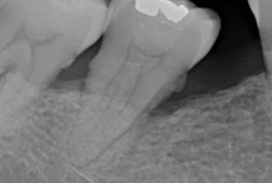 Avant · 2014 – Cas clinique du Docteur Victor Hazout. Défaut osseux le long d'une molaire inférieure : radiographie avant le traitement (2014), puis sept ans plus tard (2021). Les deux clichés n'ont pas tout à fait la même incidence ; la comparaison reste indicative.