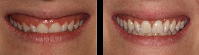 Cas clinique du Docteur Victor Hazout : sourire gingival avant puis après remodelage de la gencive au laser. Image disponible seulement en petite définition, affichée sans agrandissement.