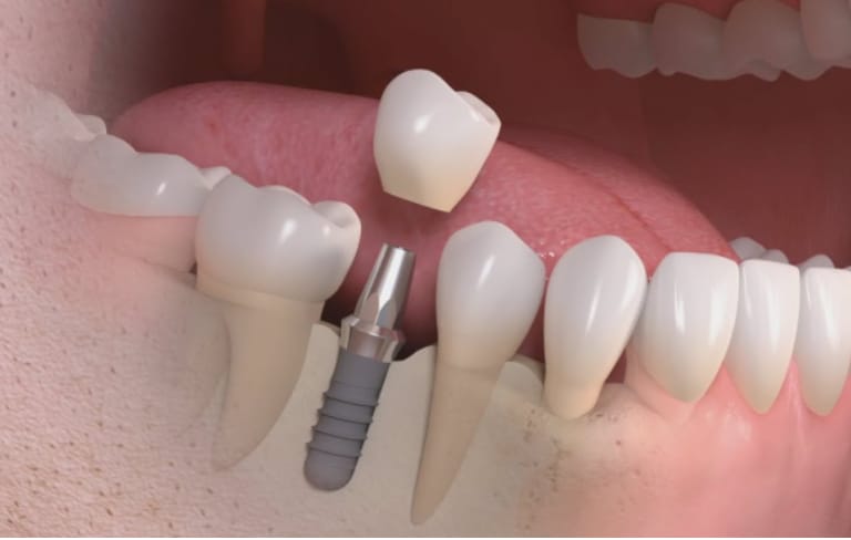 Illustration : un implant et sa couronne.