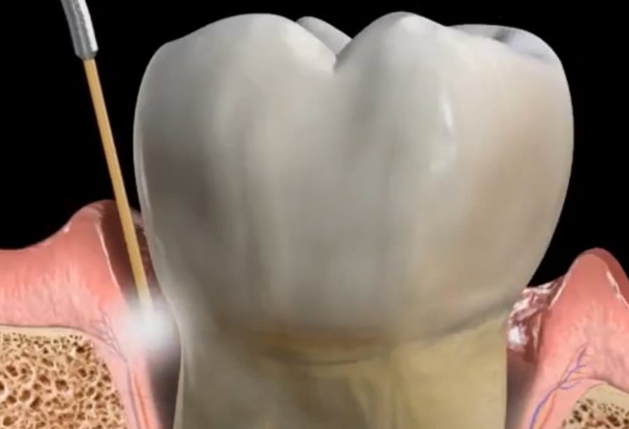 Illustration : comment un laser agit sur les tissus de la bouche.