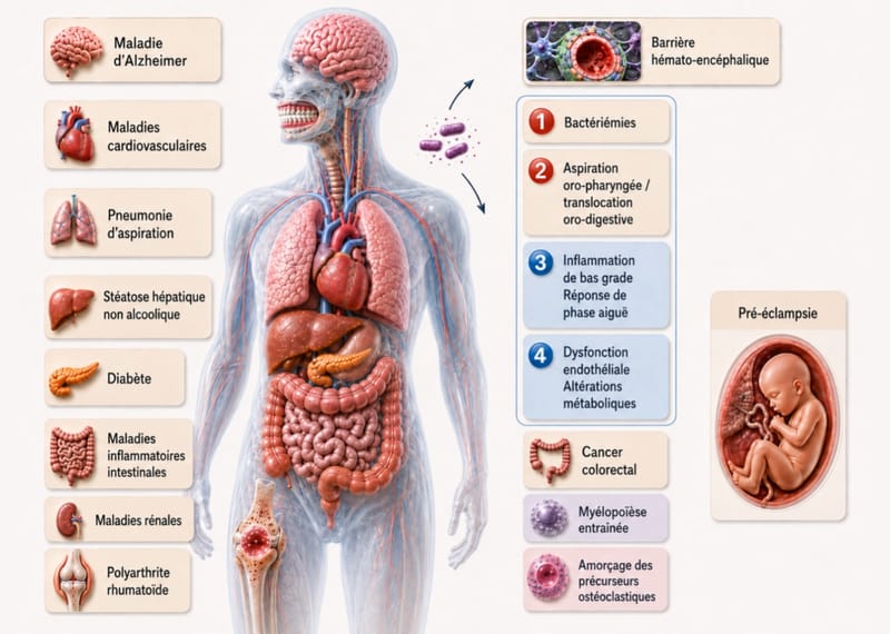 Infographie pédagogique : organes et maladies associés à la parodontite, et principaux mécanismes à l'étude (bactériémies, aspiration et translocation digestive, inflammation de bas grade, dysfonction endothéliale, myélopoïèse entraînée). Des associations retrouvées et des mécanismes à l'étude.